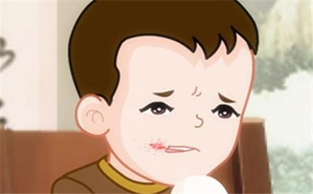 口角炎吃什么药